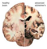 Alzheimer's Brain